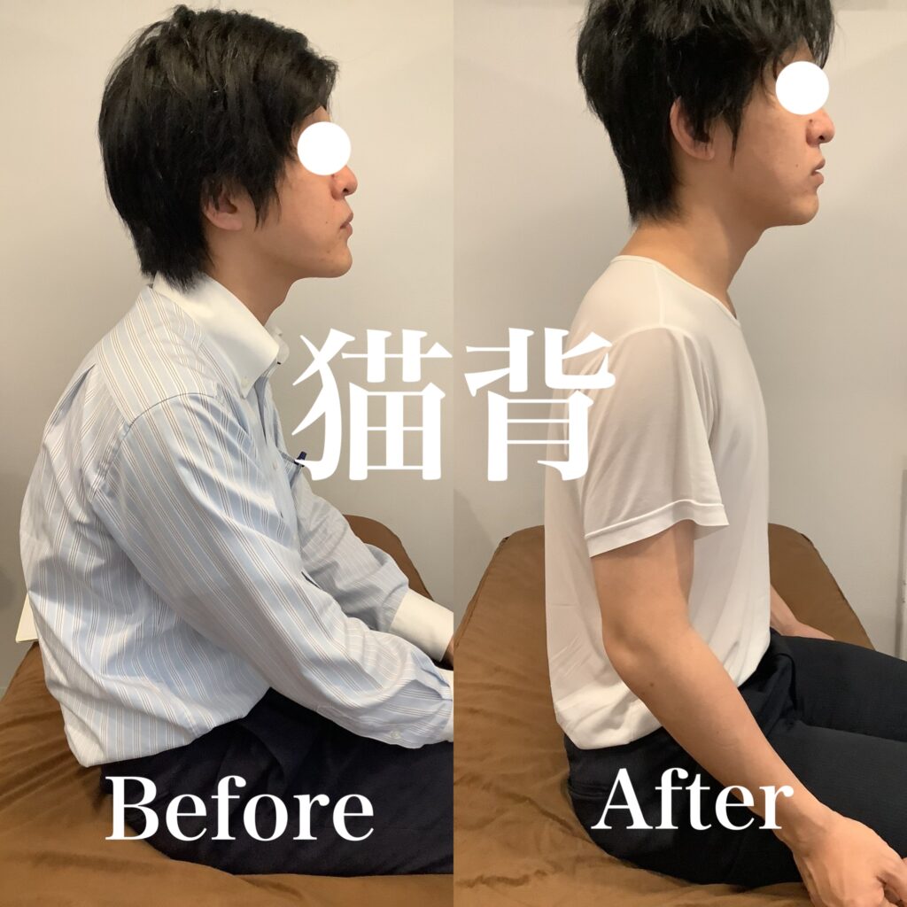 猫背