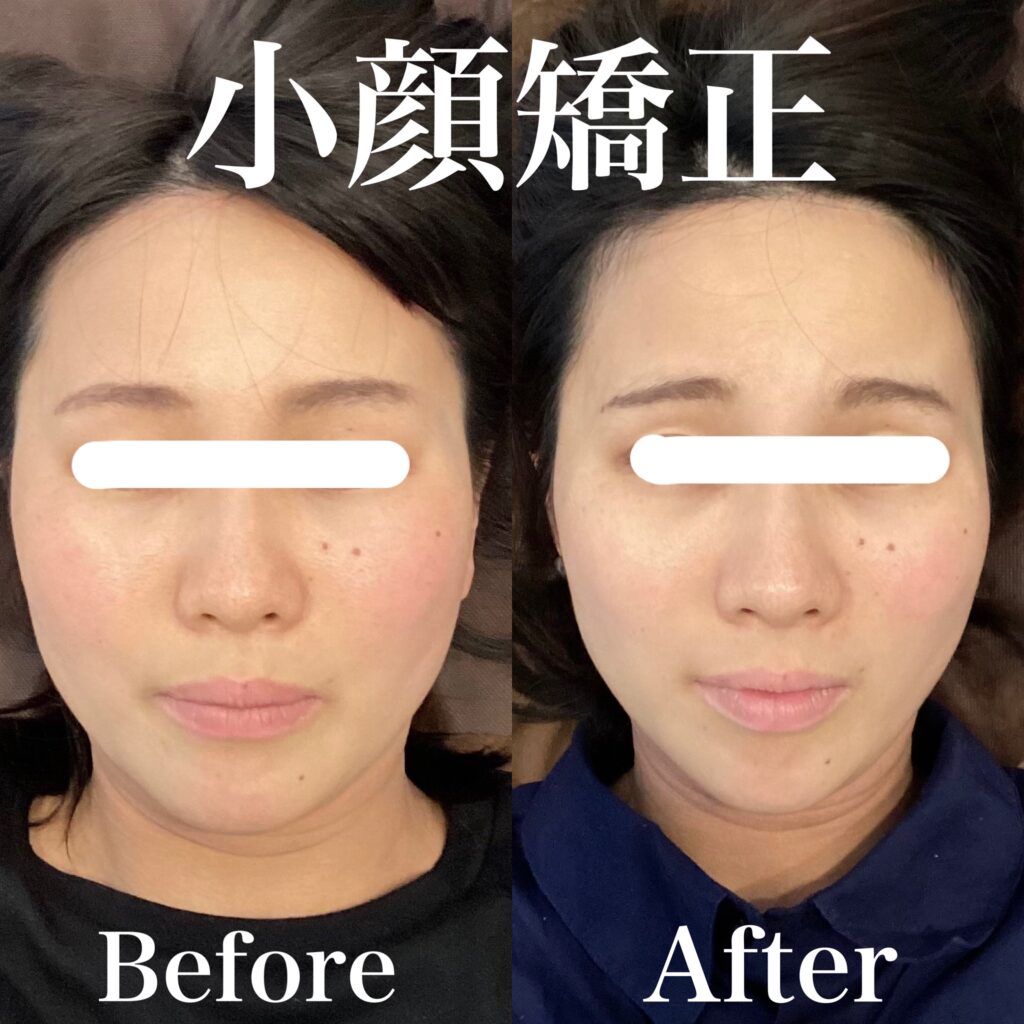 小顔矯正